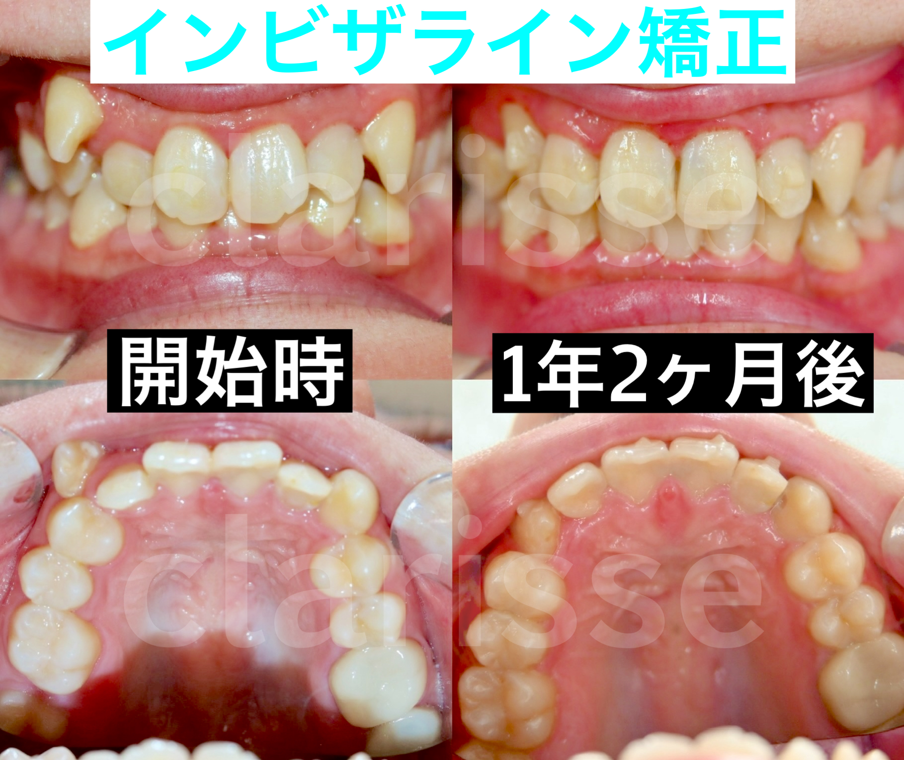 症例写真